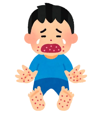 手足口病、流行中です